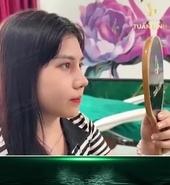 Nhiều chị em lo lắng khi bác sĩ tư vấn nâng mũi kết hợp cuộn cánh mũi thì sẽ để lại sẹo, vì thường cuộn cánh mũi sẽ được thực hiện bên cắt bên ngoài mũi.